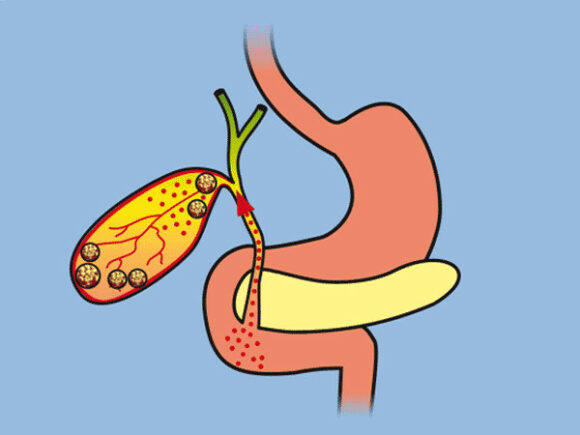 Gallensteine schematische Darstellung