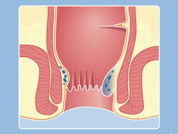 Hemorrhoids graphical representation