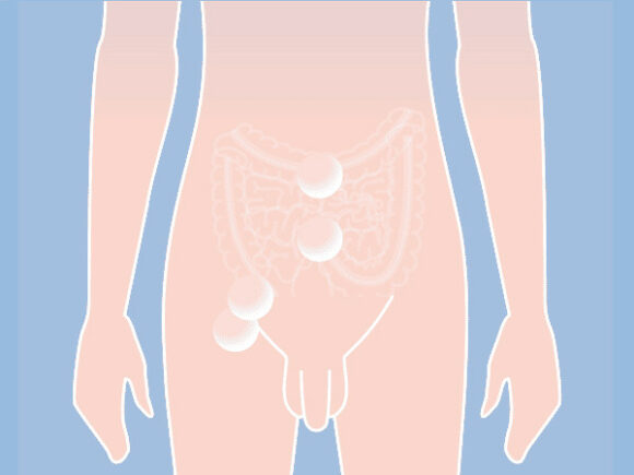 Inguinal Hernia graphical representation