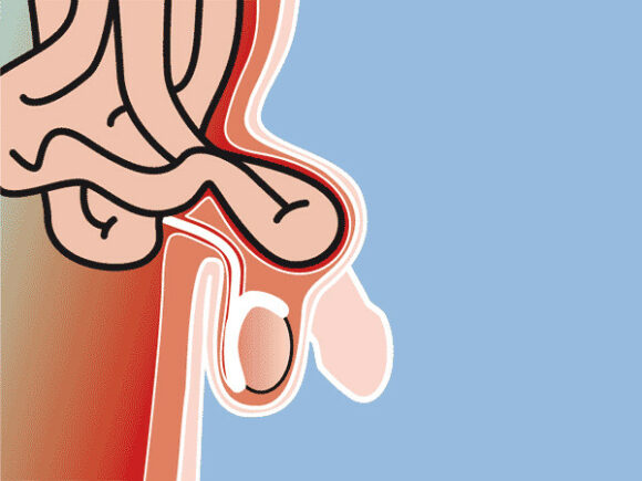 Inguinal Hernia / groin hernia graphical representation