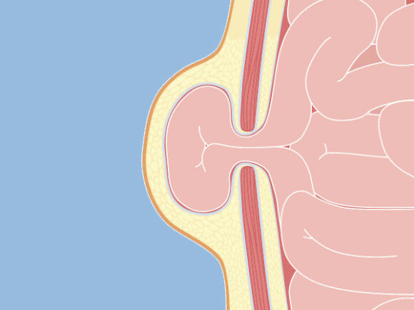 Umbilical Hernia graphical representation