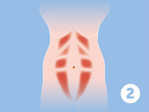 Rektusdiastase schematische Darstellung