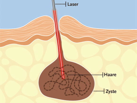 Steissbeinfistel / Sinus pilonidalis schematische Darstellung